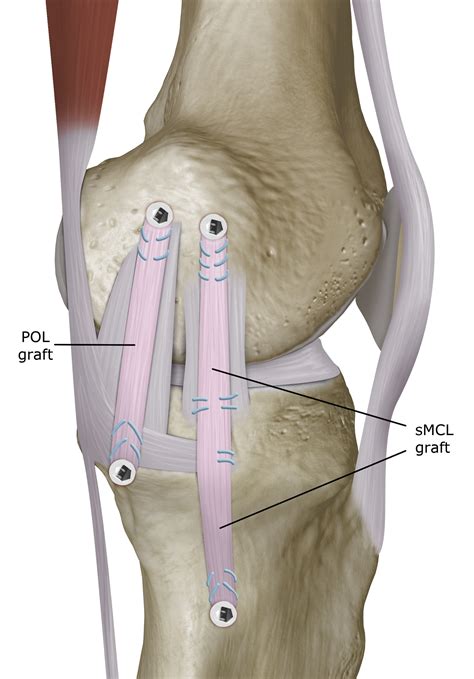 ligament in knee surgery